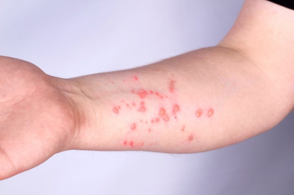 Cuiabá não registra casos de Mpox e mantém vigilância preventiva ativa