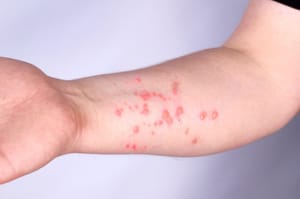 Cuiabá não registra casos de Mpox e mantém vigilância preventiva ativa